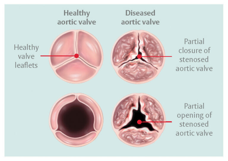Aortic Stenosis Anatomy Diagnosis Treatment The Valve Clinic Aortic Stenosis Anatomy Diagnosis Treatment The Valve Clinic